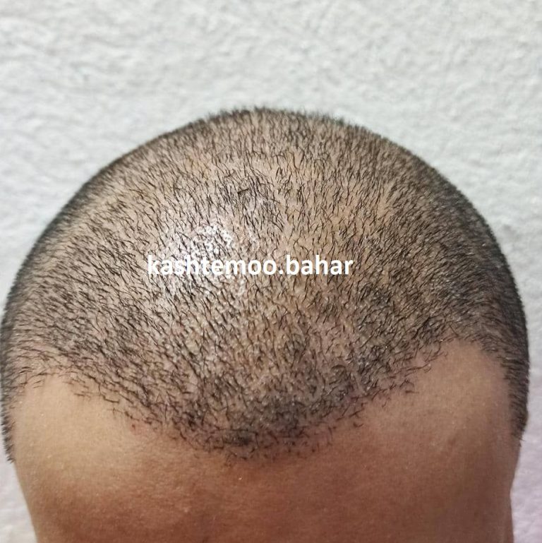 مراحل رشد مو پس از کاشت + فیلم و عکس